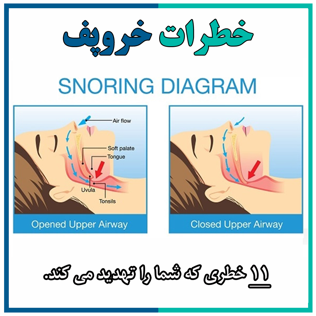 11 خطر خروپف را بشناسیم
